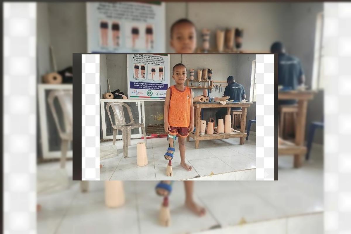 Children With Limb Differences in Nigeria: Between Stigma, Faith, and the Fight for a Device