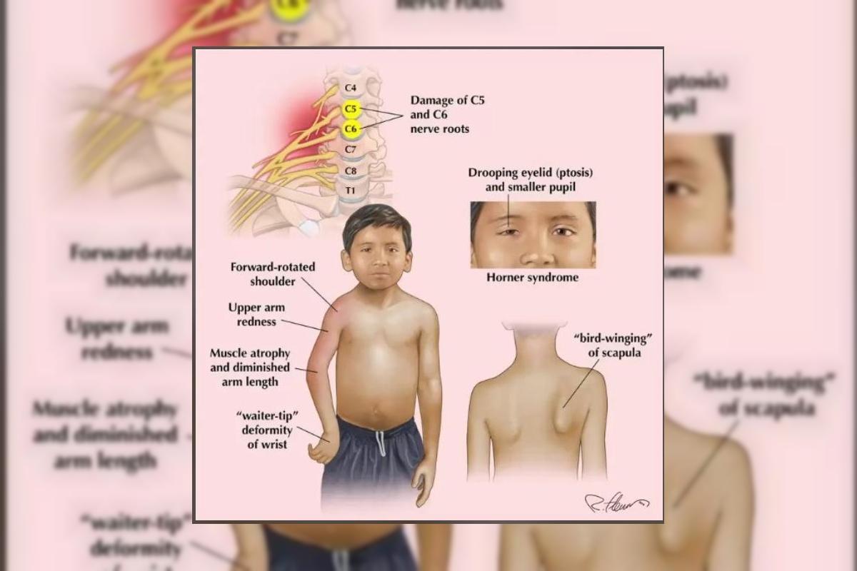 Brachial Plexus Injury in Newborns: The Birth Complication Nigerian Parents Are Missing