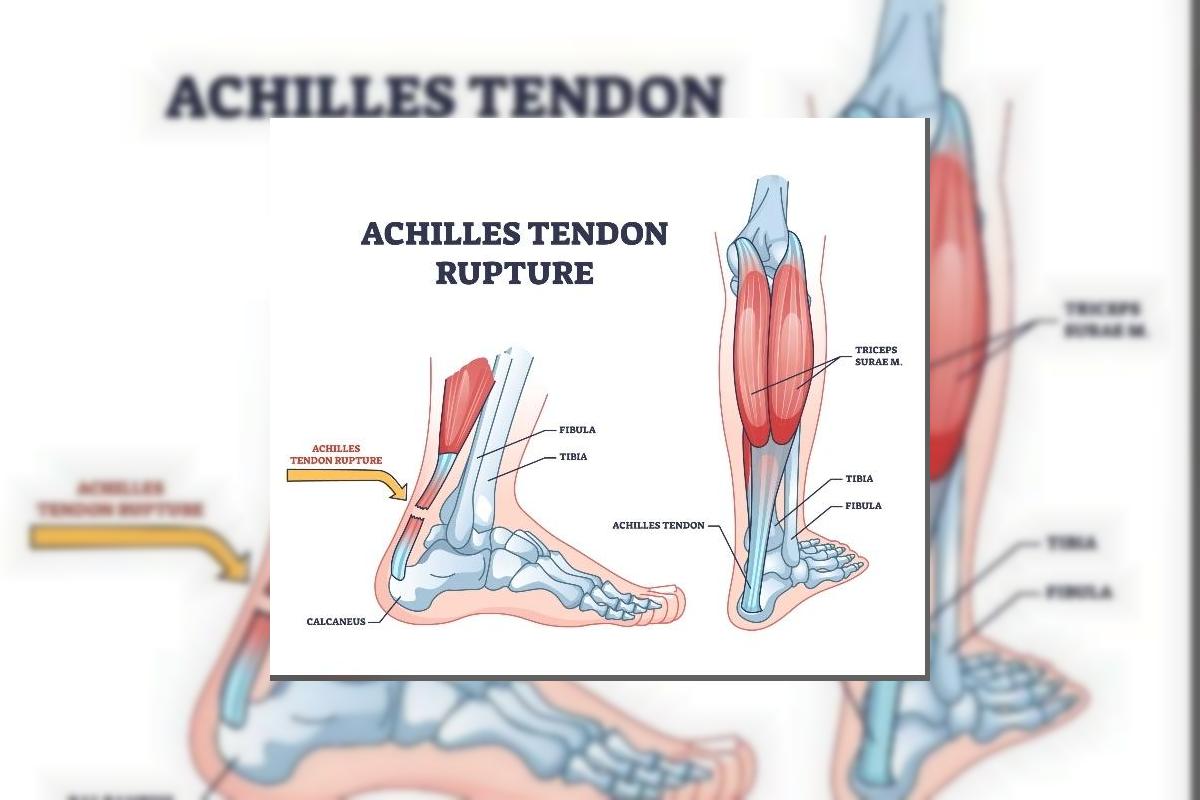 Achilles Tendon Rupture in Nigeria: The Sports Injury That Ends Careers